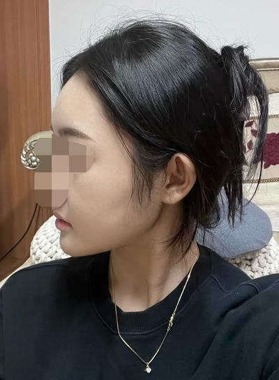얼굴지방흡입 이중턱 7주차, 살 빠졌냐는 말 계속 들어요 사진 4 — 아바성형외과 이중턱·윤곽 후기
