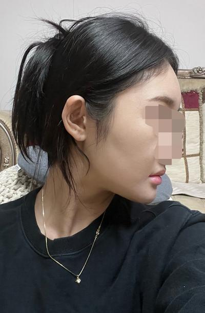얼굴지방흡입 이중턱 7주차, 살 빠졌냐는 말 계속 들어요 사진 5 — 아바성형외과 이중턱·윤곽 후기