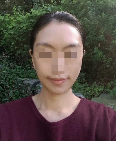 안면거상 지방이식 12주차, 턱선 말끔해지고 젊어졌어요 — 아바성형외과 환자 후기 사진