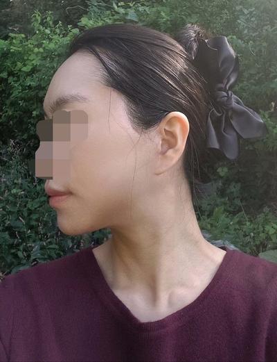 안면거상 지방이식 12주차, 턱선 말끔해지고 젊어졌어요 사진 5 — 아바성형외과 안면거상 후기