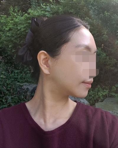 안면거상 지방이식 12주차, 턱선 말끔해지고 젊어졌어요 사진 6 — 아바성형외과 안면거상 후기