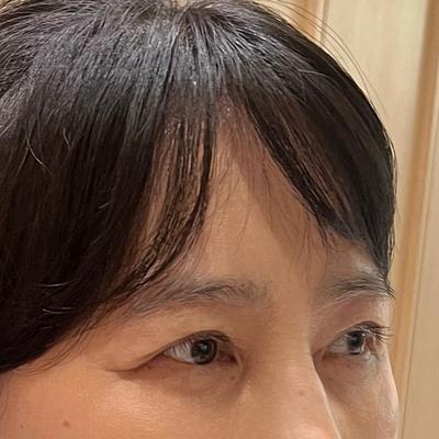 거상수술 8주차, 점점 자연스러워지고 훨씬 어려졌어요 — 아바성형외과 환자 후기 사진
