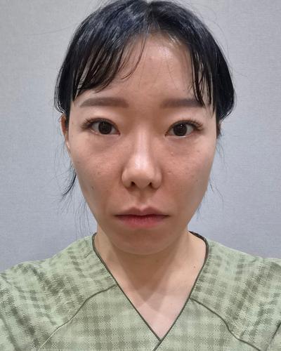 눈밑지방재배치 8주차, 눈밑 정리되니 얼굴이 깔끔해요 사진 2 — 아바성형외과 눈밑지방재배치 후기