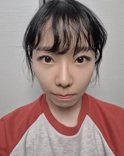 눈밑지방재배치 8주차, 눈밑 정리되니 얼굴이 깔끔해요 사진 3 — 아바성형외과 눈밑지방재배치 후기