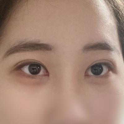 매몰＋윗트임 2개월차, 짝짝이 눈 탈출하고 부러움 받아요 — 아바성형외과 환자 후기 사진
