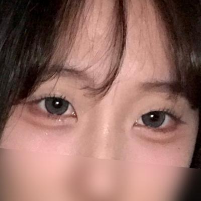 매몰＋윗트임 2개월차, 짝짝이 눈 탈출하고 부러움 받아요 사진 2 — 아바성형외과 쌍꺼풀·눈성형 후기