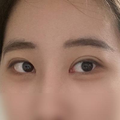 매몰＋윗트임 2개월차, 짝짝이 눈 탈출하고 부러움 받아요 사진 4 — 아바성형외과 쌍꺼풀·눈성형 후기