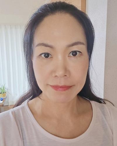 하안검 2주차, 눈밑주름 없어지고 5년은 젊어진 것 같아요 — 아바성형외과 환자 후기 사진
