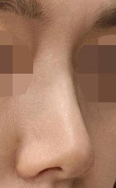 콧볼축소 3주차, 걱정했던 흉터도 생각보다 안 보여요 사진 4 — 아바성형외과 코성형 후기