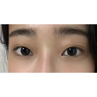 눈밑지방재배치 재수술 6주차, 짝짝이 고민 해결됐어요 — 아바성형외과 환자 후기 사진