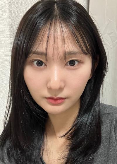 눈밑 붓기 다 빠지고 피곤해보인다는 말 없어졌어요 — 아바성형외과 환자 후기 사진