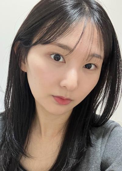 눈밑 붓기 다 빠지고 피곤해보인다는 말 없어졌어요 사진 4 — 아바성형외과 눈밑지방재배치 후기