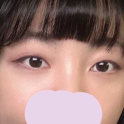 눈밑지방재배치 1개월차, 후회 없는 투자였어요 — 아바성형외과 환자 후기 사진