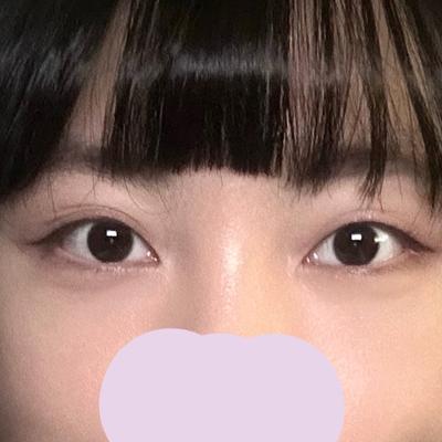 눈밑지방재배치 1개월차, 후회 없는 투자였어요 사진 4 — 아바성형외과 눈밑지방재배치 후기