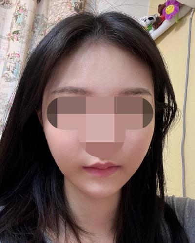 얼굴 아큐 지방흡입 7주차, 턱선 또렷해지고 갸름해졌어요 — 아바성형외과 환자 후기 사진