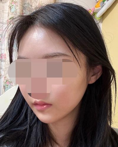 얼굴 아큐 지방흡입 7주차, 턱선 또렷해지고 갸름해졌어요 사진 5 — 아바성형외과 이중턱·윤곽 후기