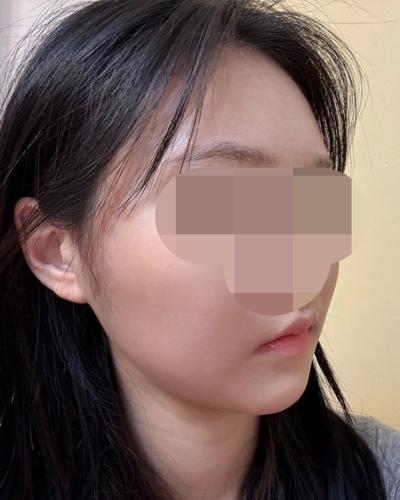 얼굴 아큐 지방흡입 7주차, 턱선 또렷해지고 갸름해졌어요 사진 6 — 아바성형외과 이중턱·윤곽 후기