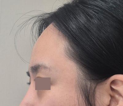 이마축소 5주차, 처음엔 감각 없어 힘들었지만 지금은 사진 3 — 아바성형외과 이마거상 후기