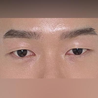 꼼꼼하게 수술받았더니 결과 만족, 진짜 잘했다 싶어요 — 아바성형외과 환자 후기 사진