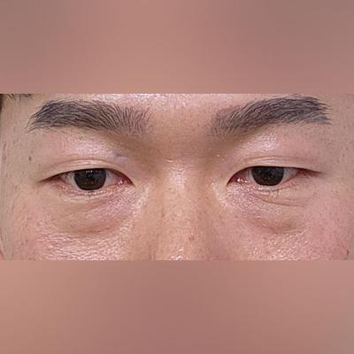 꼼꼼하게 수술받았더니 결과 만족, 진짜 잘했다 싶어요 사진 2 — 아바성형외과 기타 후기