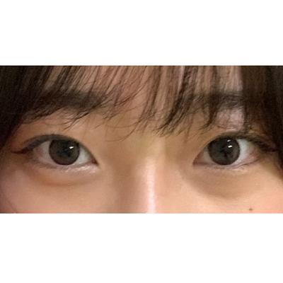 눈밑지방재배치 재수술 4주차, 렌즈도 끼고 깔끔해졌대요 사진 2 — 아바성형외과 눈밑지방재배치 후기