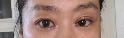 쌍꺼풀 풀림·짝눈 교정 2주차, 붓기 빠지면 더 이쁠 것 같아요 — 아바성형외과 환자 후기 사진