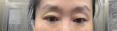 쌍꺼풀 풀림·짝눈 교정 2주차, 붓기 빠지면 더 이쁠 것 같아요 사진 2 — 아바성형외과 쌍꺼풀·눈성형 후기