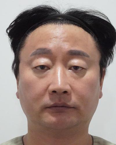 수술 15주차, 자연스러운데 어려보인다는 얘기 들어요 사진 2 — 아바성형외과 기타 후기