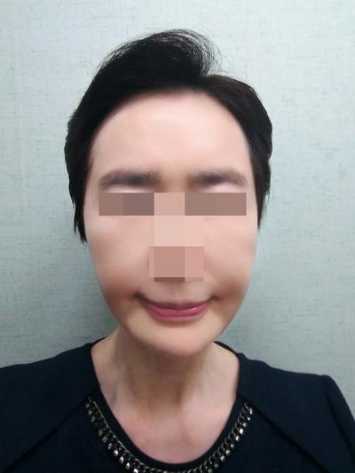 이마거상＋아큐스컬프 후기, 20년은 젊어진 것 같아요 — 아바성형외과 환자 후기 사진
