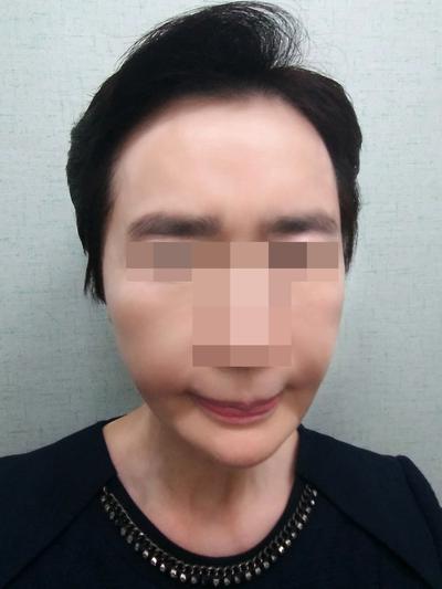 이마거상＋아큐스컬프 후기, 20년은 젊어진 것 같아요 사진 3 — 아바성형외과 안면거상 후기