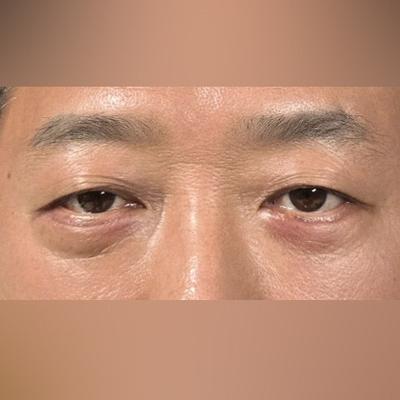 아버지 눈밑지방재배치 후기, 과잉진료 없이 만족스러워요 — 아바성형외과 환자 후기 사진