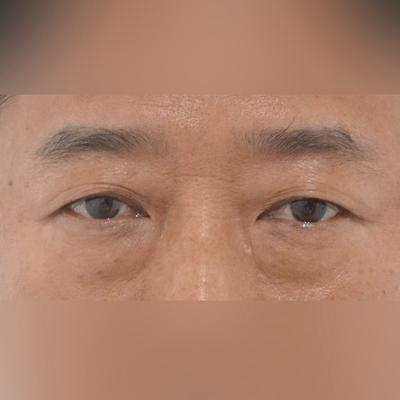 아버지 눈밑지방재배치 후기, 과잉진료 없이 만족스러워요 사진 2 — 아바성형외과 눈밑지방재배치 후기