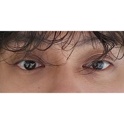 아바성형외과 8주 경과, 회복 빠르고 효과도 확실해서 만족해요 — 아바성형외과 환자 후기 사진