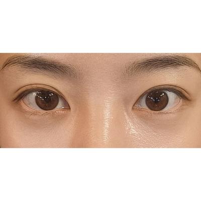 눈밑지방재배치 4주차, 인상 밝아졌다는 말에 진작 할 걸 — 아바성형외과 환자 후기 사진