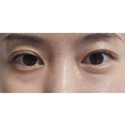 눈밑지방재배치 4주차, 인상 밝아졌다는 말에 진작 할 걸 사진 2 — 아바성형외과 눈밑지방재배치 후기