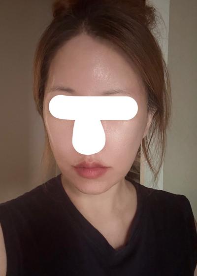 안면거상＋아큐 7주차, 살아난 턱선에 아주 만족해요 사진 5 — 아바성형외과 안면거상 후기