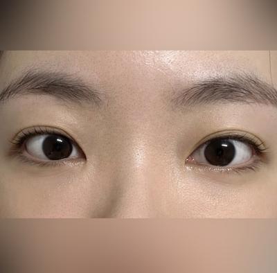 눈성형 환자 후기 — 브라운 성형외과 김승수 원장... (185)