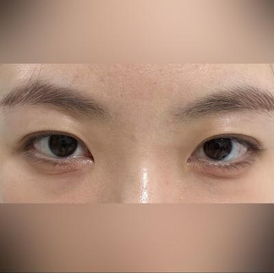 눈밑지방재배치 8주차, 얼굴 밝아졌다는 말 계속 들어요 사진 2 — 아바성형외과 눈밑지방재배치 후기
