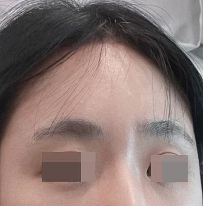 이마거상축소술, 태평양 이마가 확 줄어들었어요 — 아바성형외과 환자 후기 사진
