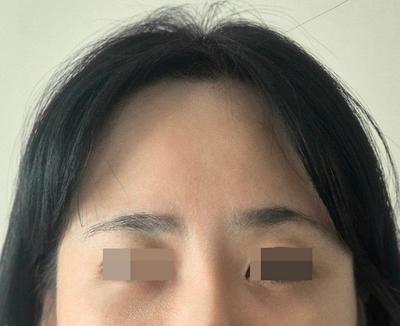 이마거상축소술, 태평양 이마가 확 줄어들었어요 사진 2 — 아바성형외과 안면거상 후기