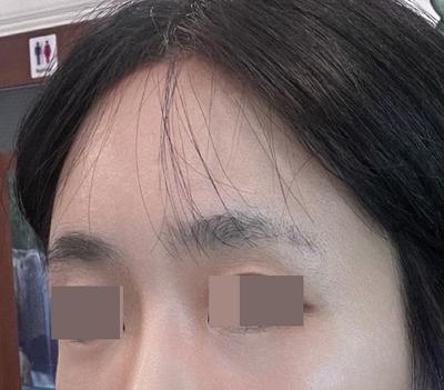 이마거상축소술, 태평양 이마가 확 줄어들었어요 사진 4 — 아바성형외과 안면거상 후기