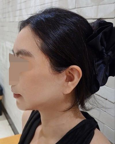 안면거상 6주차～2개월, 붓기 빠지면서 자리 완전 잡았어요 — 아바성형외과 환자 후기 사진