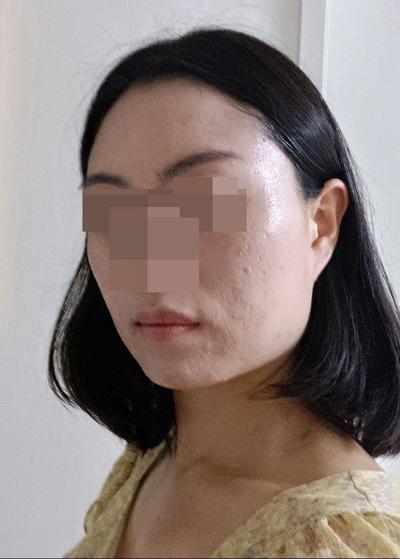 안면거상 6주차～2개월, 붓기 빠지면서 자리 완전 잡았어요 사진 2 — 아바성형외과 안면거상 후기