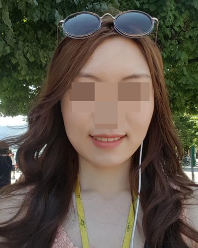 안면거상 6주차～2개월, 붓기 빠지면서 자리 완전 잡았어요 사진 3 — 아바성형외과 안면거상 후기