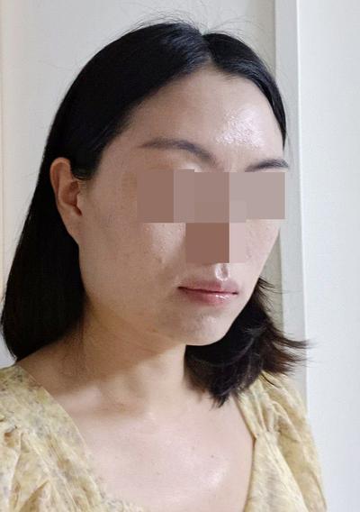 안면거상 6주차～2개월, 붓기 빠지면서 자리 완전 잡았어요 사진 4 — 아바성형외과 안면거상 후기