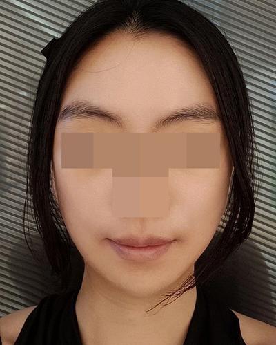 안면거상 6주차～2개월, 붓기 빠지면서 자리 완전 잡았어요 사진 5 — 아바성형외과 안면거상 후기