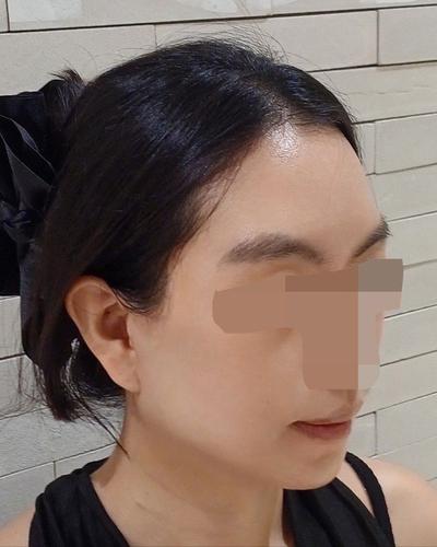안면거상 6주차～2개월, 붓기 빠지면서 자리 완전 잡았어요 사진 6 — 아바성형외과 안면거상 후기