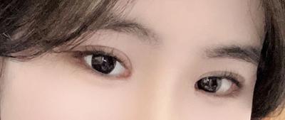 답답하고 작던 눈, 수술 직후 통증 없고 멍붓기만 있었어요 — 아바성형외과 환자 후기 사진