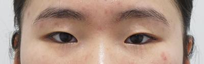 답답하고 작던 눈, 수술 직후 통증 없고 멍붓기만 있었어요 사진 2 — 아바성형외과 쌍꺼풀·눈성형 후기