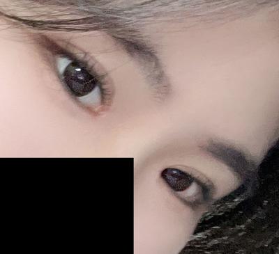 답답하고 작던 눈, 수술 직후 통증 없고 멍붓기만 있었어요 사진 3 — 아바성형외과 쌍꺼풀·눈성형 후기